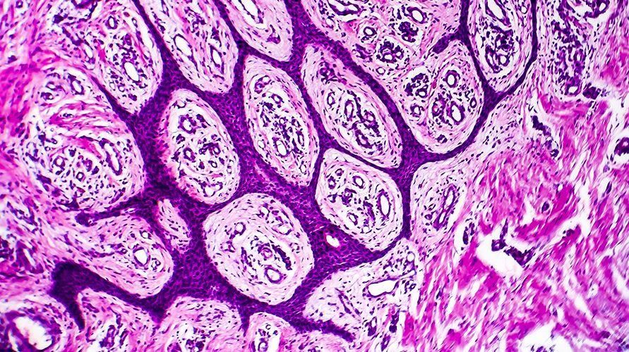 Adenokarsinomu, Semptomsuz Görünebilen Kanser Hücrelerini Tanıyın