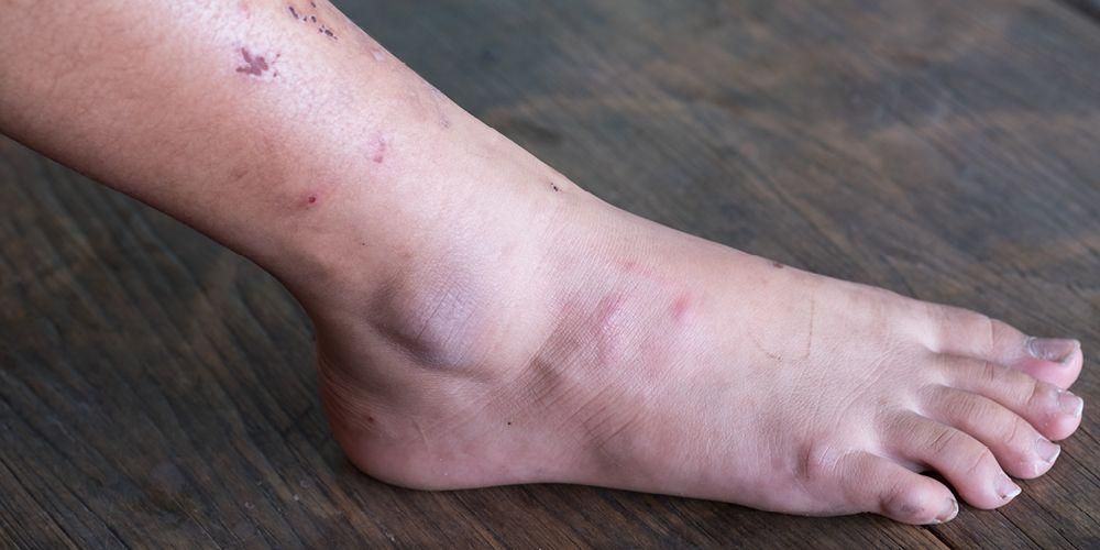 Ketahui ciri-ciri luka diabetes pada kaki dan cara mencegahnya