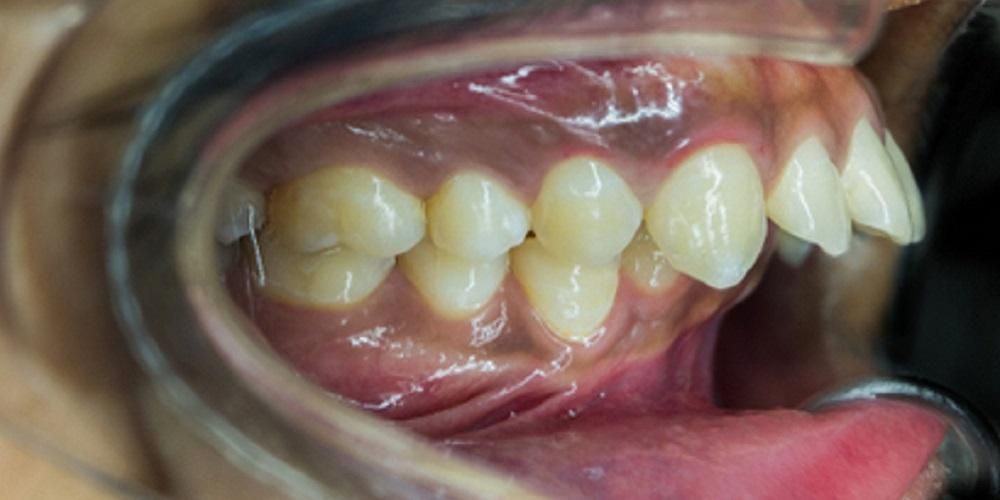 أنواع علاج الأسنان الفعال للحصول على أسنان نظيفة
