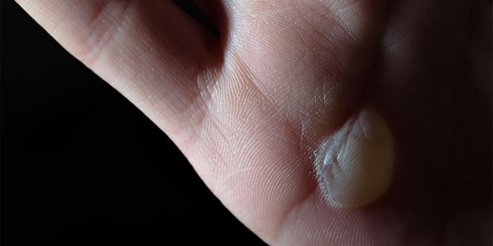 5 причини за образуване на мехури по кожата и как да се третира правилно