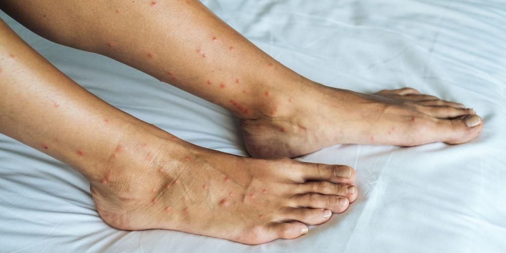 Червените петна по краката могат да бъдат причинени от тези 9 болести