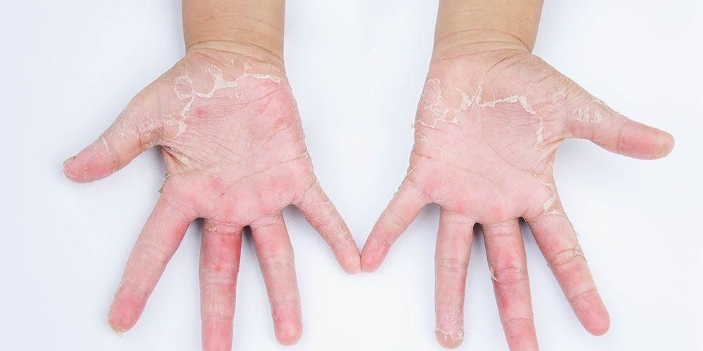 12 أسباب لتقشير جلد اليد: العوامل البيئية للمرض