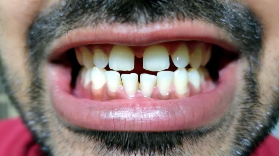 كيفية التعامل مع الأسنان النادرة في الوسط حتى تكون أسنانك أجمل