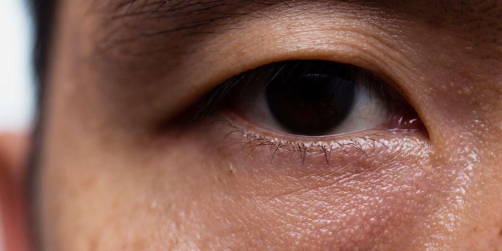 بما في ذلك اضطرابات العين ، دعونا نتعرف على الأسباب الستة للعيون الغارقة