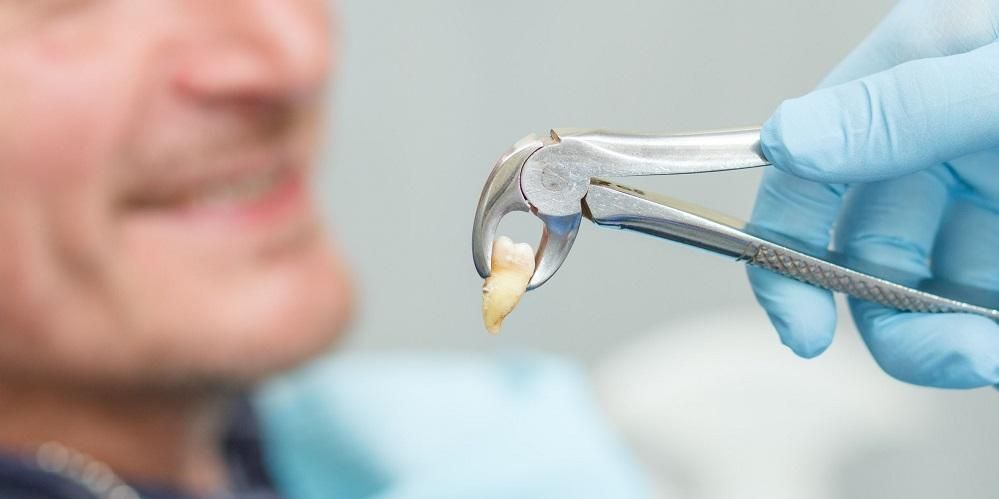 Questa è la fascia di costo per l'estrazione del dente del giudizio dal dentista